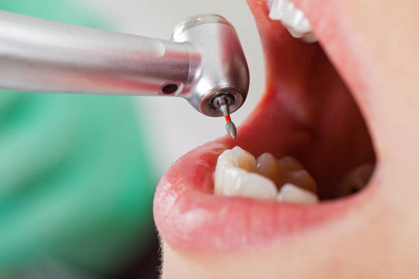Best Emergency Dentist for Lost Fillings or Crowns in Parma, OH